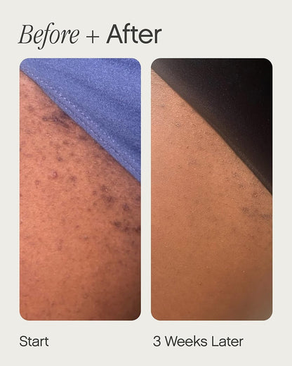 High Roller Ingrown Hair Serum | Roll-On Tonic to Soothe and Calm Irritated Skin on Face, Armpits and Bikini Areas | Contains Salicylic and Glycolic Acid | Vegan and Cruelty-Free (1.7 Fl Oz)